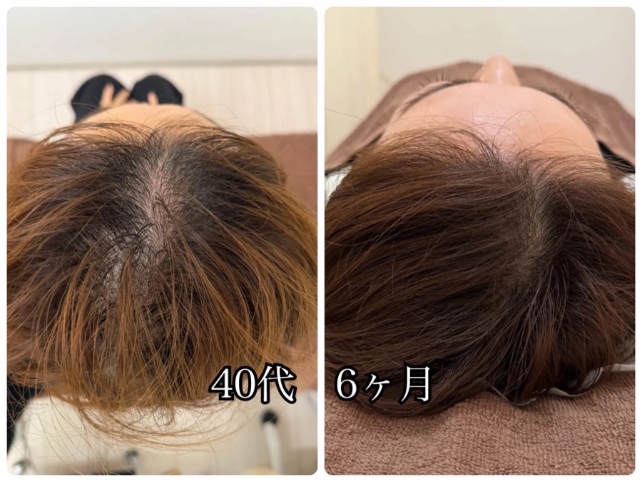40代女性のビフォーアフター（施術6ヶ月）、頭頂部の写真