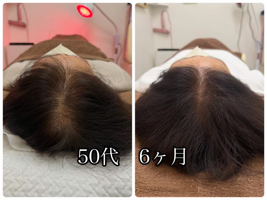 50代女性のビフォーアフター（施術6ヶ月）、頭頂部の写真