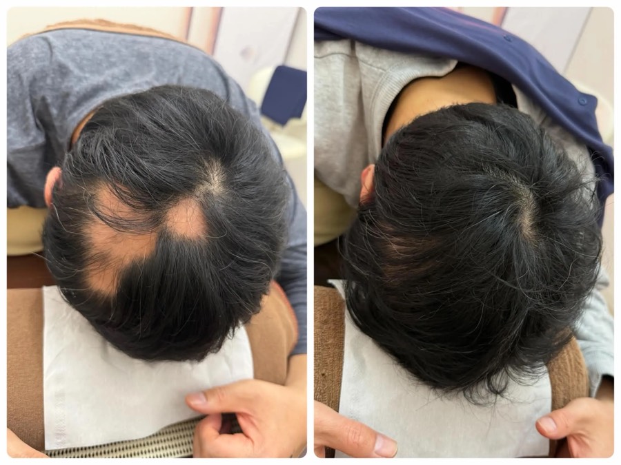 40代男性のビフォーアフター（施術7ヶ月）、円形の脱毛部分の変化