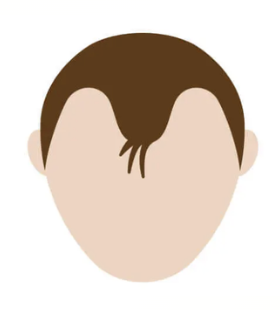 M型の薄毛（両サイドの生え際が後退している頭部のイラスト）