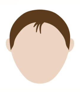 前頭型の薄毛（生え際が後退している頭部のイラスト）